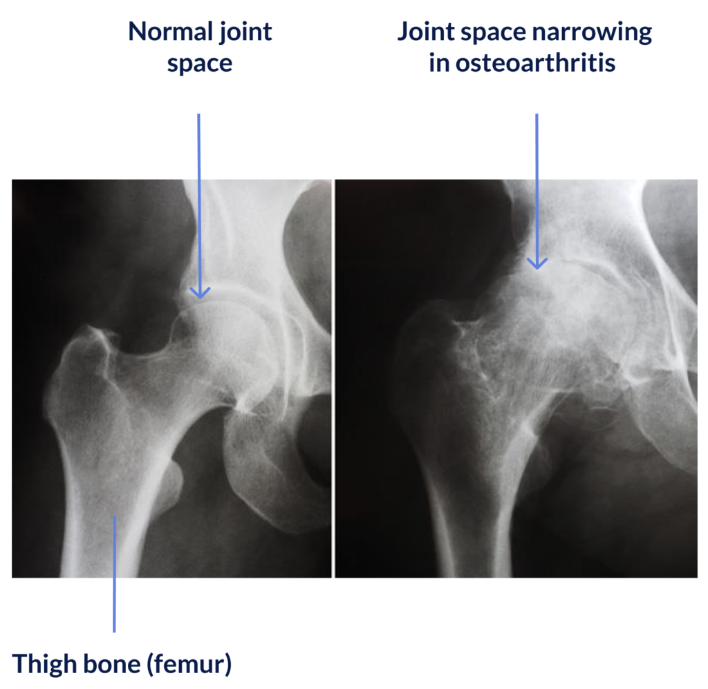 Osteophytes Hip