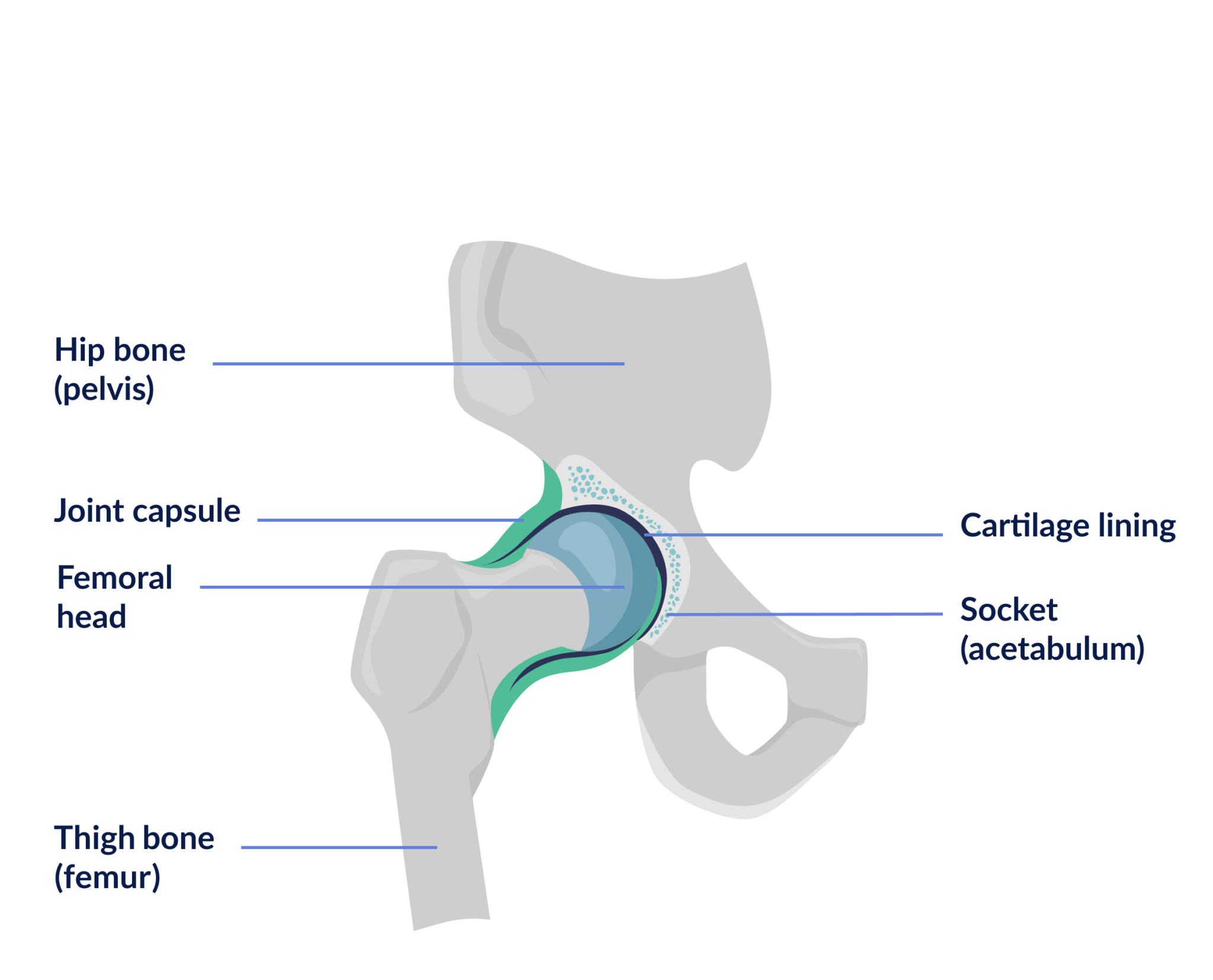 Anatomy, osteoarthritis and total hip replacement surgery Support