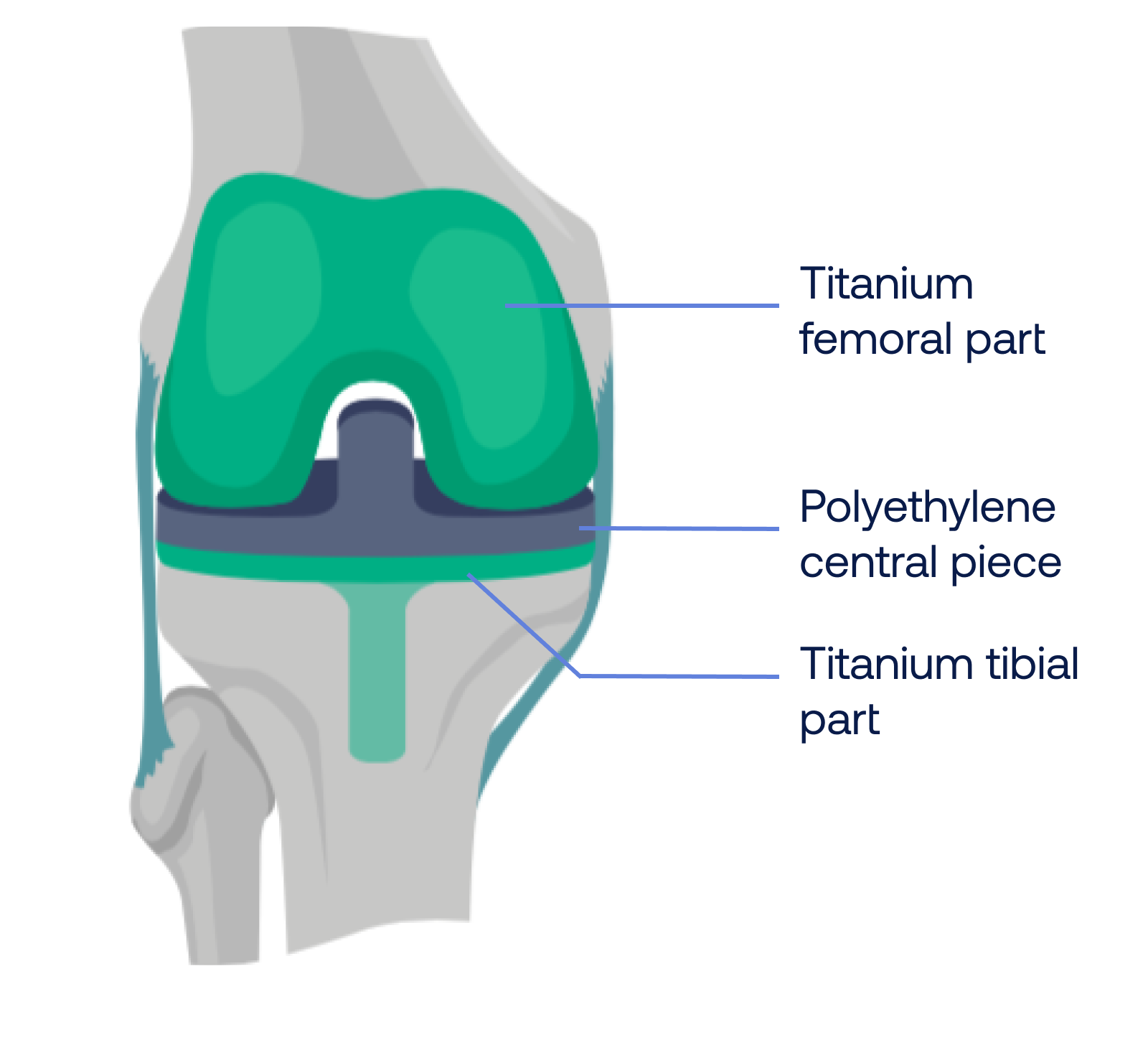 Anatomy, osteoarthritis, and knee replacement surgery Support